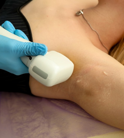 Laser Hair Reduction